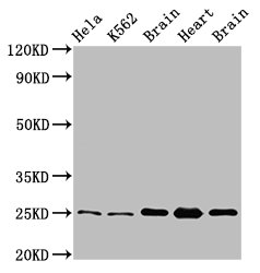 IHC image diluted at 1:560 and staining in paraffin-embedded human breast cancer performed on a Leica BondTM system. After dewaxing and hydration, antigen retrieval was mediated by high pressure in a citrate buffer (pH 6.0). Section was blocked with 10% normal goat serum 30min at RT. Then primary antibody (1% BSA) was incubated at 4°C overnight. The primary is detected by a biotinylated secondary antibody and visualized using an HRP conjugated SP system.