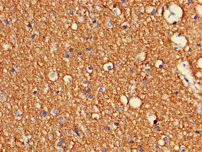 Immunohistochemistry of paraffin-embedded human ovarian cancer using CAC07024 at dilution of 1:100