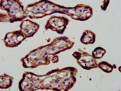 IHC image diluted at 1:600 and staining in paraffin-embedded human breast cancer performed on a Leica BondTM system. After dewaxing and hydration, antigen retrieval was mediated by high pressure in a citrate buffer (pH 6.0). Section was blocked with 10% normal goat serum 30min at RT. Then primary antibody (1% BSA) was incubated at 4°C overnight. The primary is detected by a biotinylated secondary antibody and visualized using an HRP conjugated SP system.