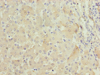 Immunohistochemistry of paraffin-embedded human colon cancer using CAC07300 at dilution of 1:100
