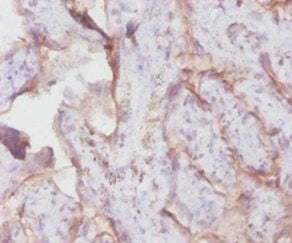 Immunocytochemistry analysis of human colon cancer using CAC07319 at dilution of 1:100