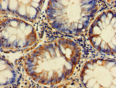 Immunohistochemistry of paraffin-embedded human endometrial cancer using CAC07415 at dilution of 1:100
