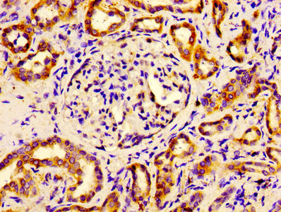 Immunohistochemistry of paraffin-embedded human breast cancer using CAC07416 at dilution of 1:100