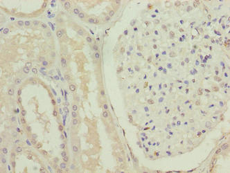 Immunohistochemistry analysis of human lung cancer using CAC07464 at dilution of 1:100