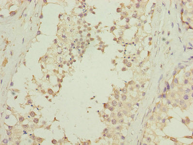 Immunohistochemistry of paraffin-embedded human prostate cancer using CAC07502 at dilution of 1:100