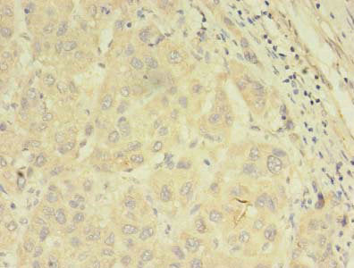Immunohistochemistry of paraffin-embedded human breast cancer using CAC07565 at dilution of 1:100
