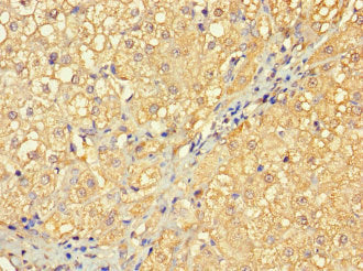Immunohistochemistry of paraffin-embedded human gastric cancer using CAC07653 at dilution of 1:100
