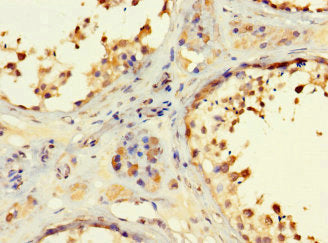 Immunohistochemistry of paraffin-embedded human melanoma using CAC07676 at dilution of 1:100
