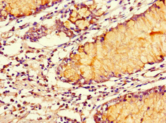 Immunohistochemistry of paraffin-embedded human gastric cancer using CAC07681 at dilution of 1:100