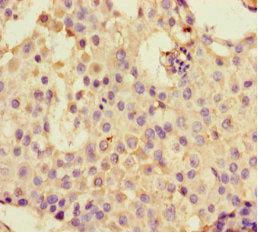 Immunohistochemistry of paraffin-embedded human lung cancer using CAC07685 at dilution of 1:100
