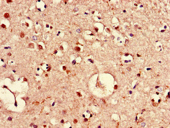 Immunohistochemistry of paraffin-embedded human liver cancer using CAC07797 at dilution of 1:100