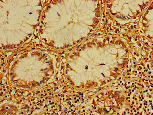 Immunohistochemistry of paraffin-embedded human pancreatic cancer using CAC07817 at dilution of 1:100