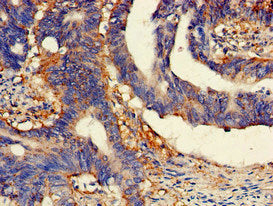Immunohistochemistry of paraffin-embedded human endometrial cancer using CAC07916 at dilution of 1:100