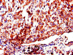Immunohistochemistry of paraffin-embedded human colon cancer using CAC07934 at dilution of 1:100