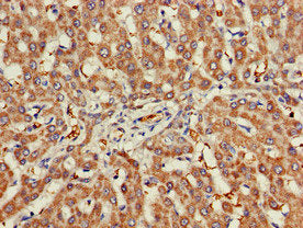 Immunohistochemistry of paraffin-embedded human colon cancer using CAC08040 at dilution of 1:100