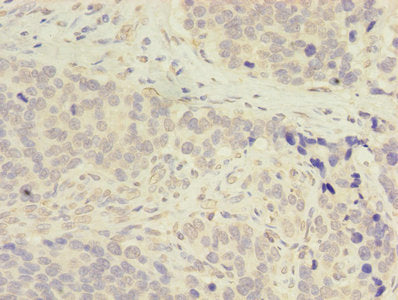 Immunohistochemistry of paraffin-embedded human cervical cancer using CAC08209 at dilution of 1:100