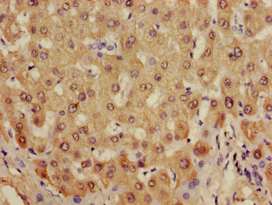 Immunohistochemistry of paraffin-embedded human liver cancer using CAC08211 at dilution of 1:100