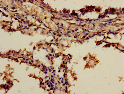 Immunohistochemistry of paraffin-embedded human gastric cancer using CAC08213 at dilution of 1:100