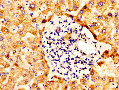 IHC image diluted at 1:400 and staining in paraffin-embedded human liver cancer performed on a Leica BondTM system. After dewaxing and hydration, antigen retrieval was mediated by high pressure in a citrate buffer (pH 6.0). Section was blocked with 10% normal goat serum 30min at RT. Then primary antibody (1% BSA) was incubated at 4°C overnight. The primary is detected by a biotinylated secondary antibody and visualized using an HRP conjugated SP system.