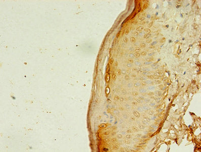 Immunohistochemistry of paraffin-embedded human lung cancer using CAC08235 at dilution of 1:100