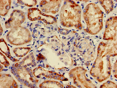 Immunohistochemistry of paraffin-embedded human breast cancer using CAC08274 at dilution of 1:100