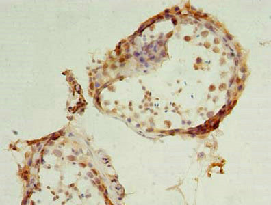 Immunohistochemistry of paraffin-embedded human cervical cancer using CAC08360 at dilution of 1:100