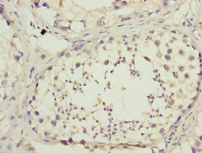 Immunohistochemistry of paraffin-embedded human breast cancer using CAC08370 at dilution of 1:100
