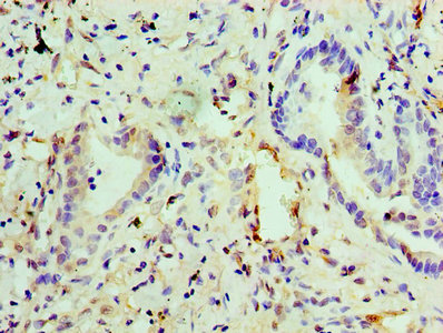 Immunohistochemistry of paraffin-embedded human breast cancer using CAC08387 at dilution of 1:100