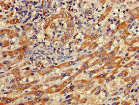 Immunohistochemistry of paraffin-embedded human pancreatic cancer using CAC08539 at dilution of 1:100