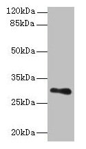 Immunohistochemistry of paraffin-embedded human breast cancer using CAC08917 at dilution of 1:100