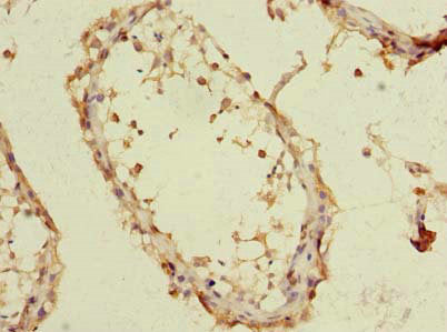 Immunohistochemistry of paraffin-embedded human colon cancer using CAC08932 at dilution of 1:100