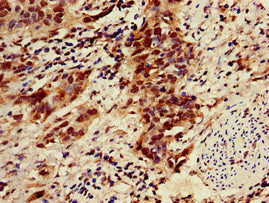 Immunohistochemistry of paraffin-embedded human cervical cancer using CAC09005 at dilution of 1:100