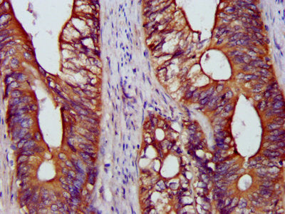 IHC image diluted at 1:1200 and staining in paraffin-embedded human prostate cancer performed on a Leica BondTM system. After dewaxing and hydration, antigen retrieval was mediated by high pressure in a citrate buffer (pH 6.0). Section was blocked with 10% normal goat serum 30min at RT. Then primary antibody (1% BSA) was incubated at 4°C overnight. The primary is detected by a biotinylated secondary antibody and visualized using an HRP conjugated SP system.