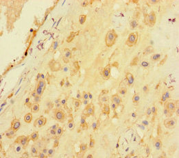 Immunohistochemistry of paraffin-embedded human melanoma using CAC09040 at dilution of 1:100
