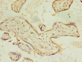 Immunohistochemistry of paraffin-embedded human breast cancer using CAC09075 at dilution of 1:100