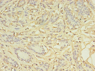 Immunohistochemistry of paraffin-embedded human colon cancer using CAC09375 at dilution of 1:100