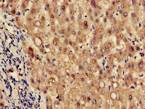 Immunohistochemistry of paraffin-embedded human colon cancer using CAC09452 at dilution of 1:100