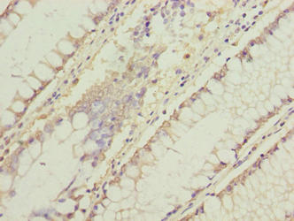 Immunohistochemistry of paraffin-embedded human liver cancer using CAC09454 at dilution of 1:100