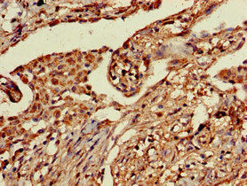 Immunohistochemistry of paraffin-embedded human pancreatic cancer using CAC09531 at dilution of 1:100