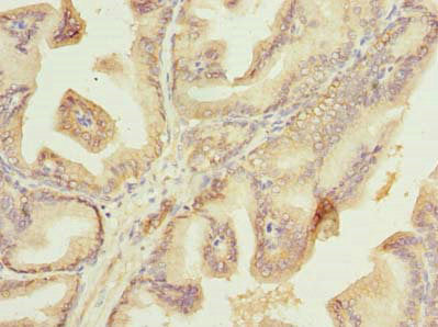 Immunohistochemistry of paraffin-embedded human breast cancer using CAC09643 at dilution of 1:100