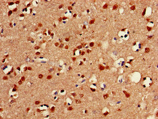 Immunohistochemistry of paraffin-embedded human breast cancer using CAC09691 at dilution of 1:100