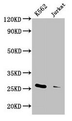 IHC image diluted at 1:1000 and staining in paraffin-embedded human breast cancer performed on a Leica BondTM system. After dewaxing and hydration, antigen retrieval was mediated by high pressure in a citrate buffer (pH 6.0). Section was blocked with 10% normal goat serum 30min at RT. Then primary antibody (1% BSA) was incubated at 4°C overnight. The primary is detected by a biotinylated secondary antibody and visualized using an HRP conjugated SP system.