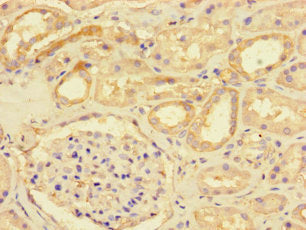 Immunohistochemistry of paraffin-embedded human liver cancer using CAC09933 at dilution of 1:100