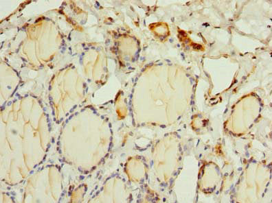 Immunohistochemistry of paraffin-embedded human breast cancer using CAC09989 at dilution of 1:100