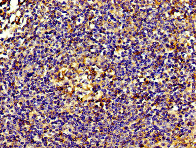IHC image diluted at 1:200 and staining in paraffin-embedded human breast cancer performed on a Leica BondTM system. After dewaxing and hydration, antigen retrieval was mediated by high pressure in a citrate buffer (pH 6.0). Section was blocked with 10% normal goat serum 30min at RT. Then primary antibody (1% BSA) was incubated at 4°C overnight. The primary is detected by a biotinylated secondary antibody and visualized using an HRP conjugated SP system.