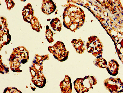 IHC image diluted at 1:300 and staining in paraffin-embedded human liver cancer performed on a Leica BondTM system. After dewaxing and hydration, antigen retrieval was mediated by high pressure in a citrate buffer (pH 6.0). Section was blocked with 10% normal goat serum 30min at RT. Then primary antibody (1% BSA) was incubated at 4°C overnight. The primary is detected by a biotinylated secondary antibody and visualized using an HRP conjugated SP system.