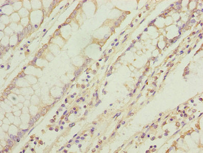 Immunohistochemistry of paraffin-embedded human gastric cancer using CAC10391 at dilution of 1:100
