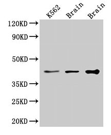 Immunohistochemistry analysis of human colon cancer using CAC10453 at dilution of 1:100