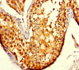 Immunohistochemistry of paraffin-embedded human prostate cancer using CAC10471 at dilution of 1:100