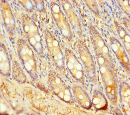 Immunohistochemistry of paraffin-embedded human colon cancer using CAC10472 at dilution of 1:100